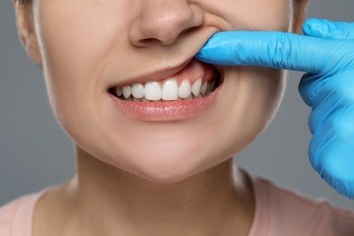 Best Gum Disease Treatment in Colorado Springs, CO | Dr. Bashi