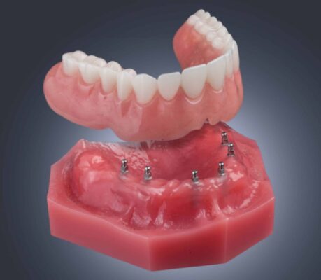 Estabilización de Dentadura en Colorado Springs, CO | Mini Implante Dental