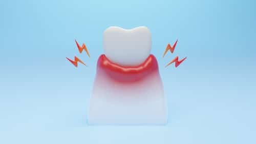 Gum Disease Treatment in Colorado Springs Best Care Dental