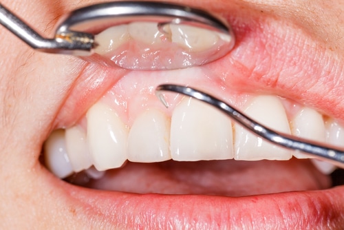 Gum Disease Treatment in Colorado Springs, CO Mini Implants