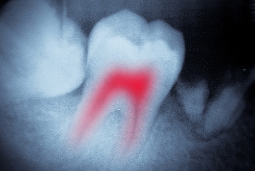 Root Canal Treatment in Colorado Springs, CO