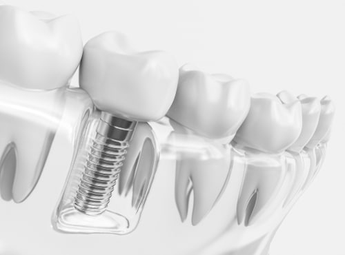 Standard Dental Implants in Colorado Springs, CO Implant Dentist