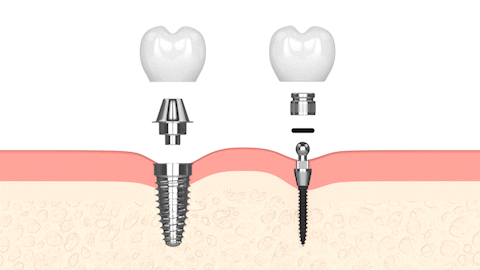 Implantes Dentales en Colorado Springs, CO