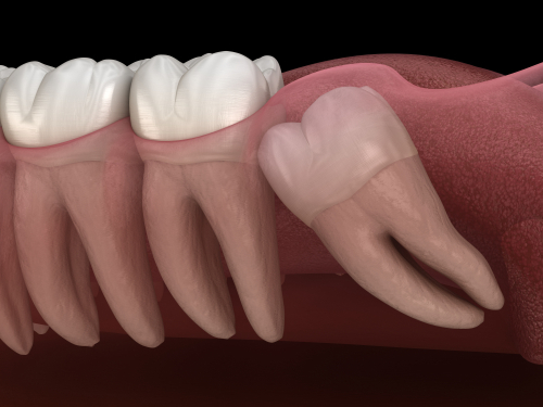 Wisdom Tooth Extraction in Colorado Springs, CO | Tooth Pain